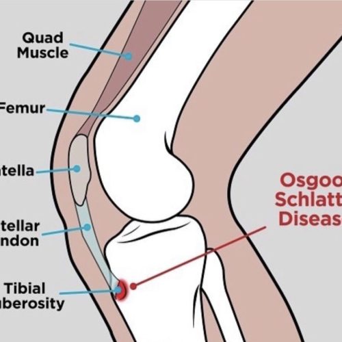 Knee Pain Brookmans Park Osteos