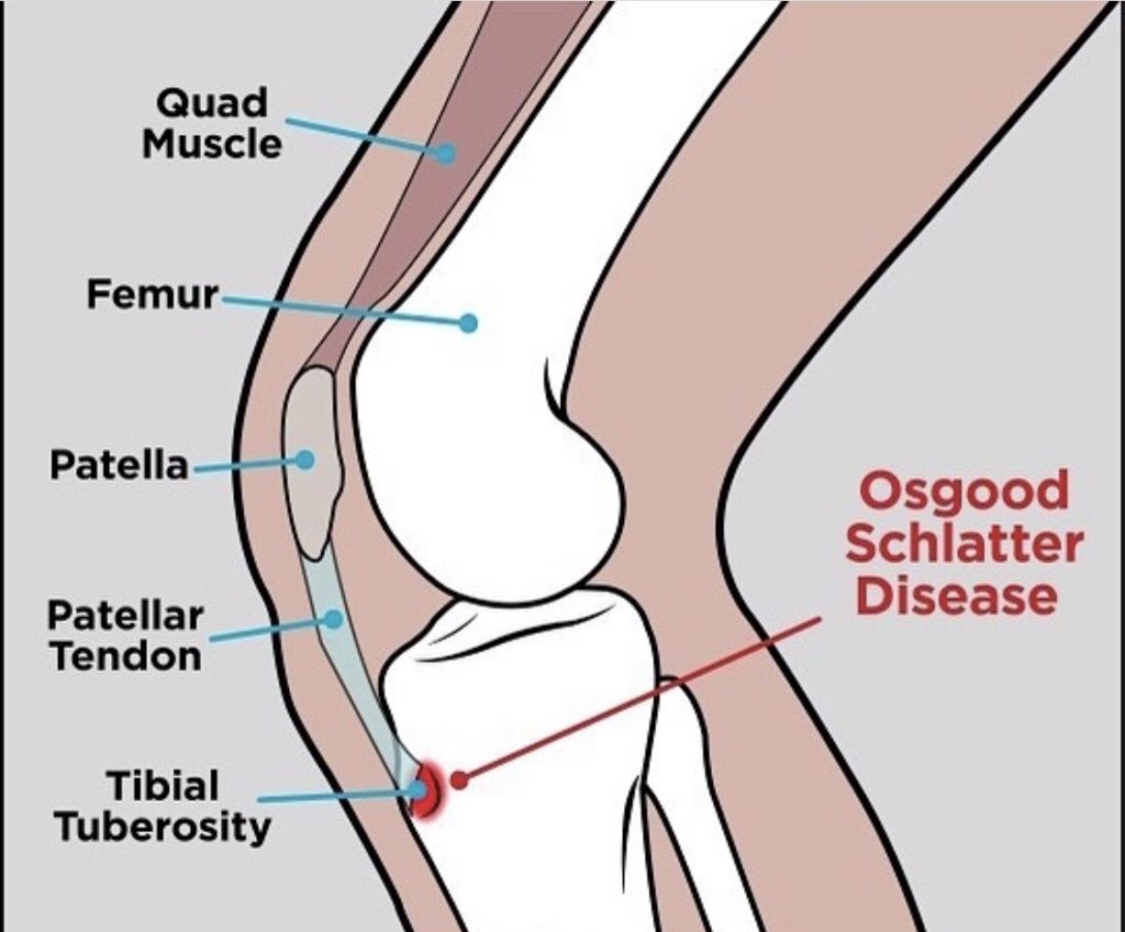 Knee Pain Brookmans Park Osteos